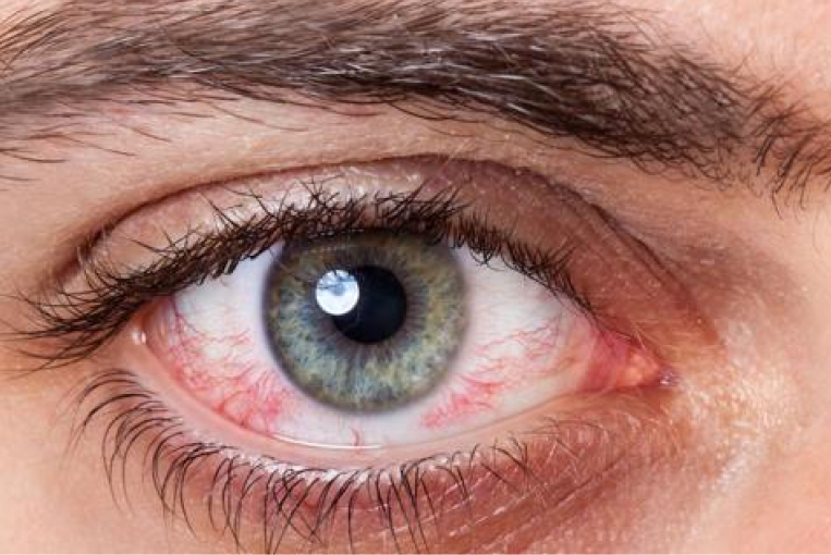 glaucoma y cuando operarse