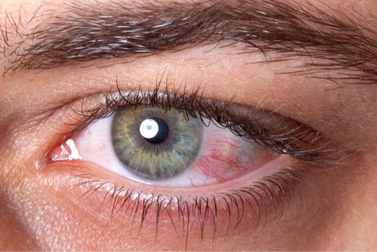 retinopatia diabetica cuando consultar al oftalmologo