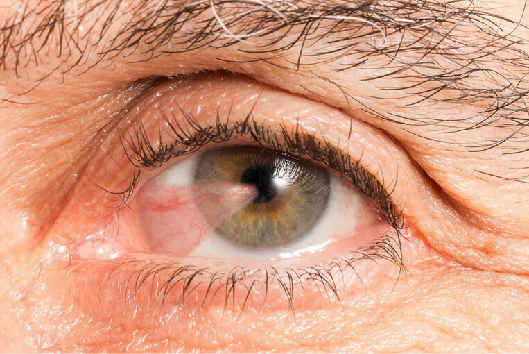 Cirugía de pterigion