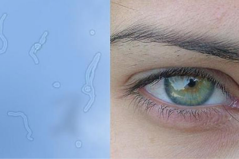 causas de las moscas volantes